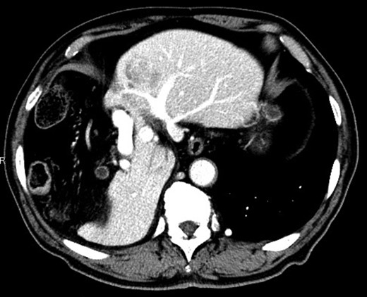 Dynamic contrast-enhanced CT showing a 40-mm nodule in S3 and hypoplasia of the right hepatic lobe with the Chilaiditi sign.
