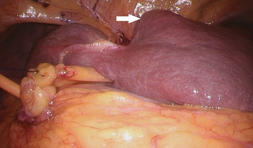 The small right hepatic lobe is not fixed to the diaphragm. The arrow (white) shows the lesion in S3.