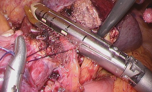 The Glissonian pedicle to S3 was transected using the SigniaTM Stapling System.