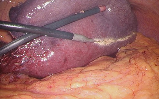 The ischemic margin of S3 was marked using electrocautery.