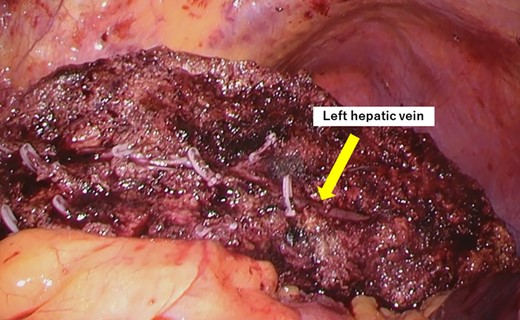 The liver parenchyma was transected along the left hepatic vein.