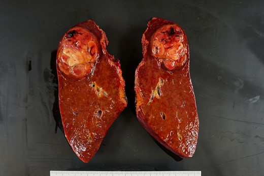 The resected specimen shows a 41-mm simple nodular type of HCC and a 5-mm tumor-free resection margin.