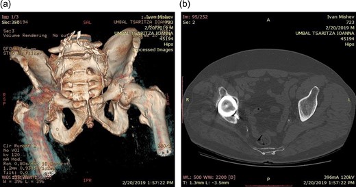 (a) CT scan of the defect. (b) CT scan of the defect.