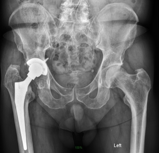 Preoperative radiograph demonstrating large acetabular defect with screw penetration.