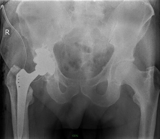Postoperative radiograph.