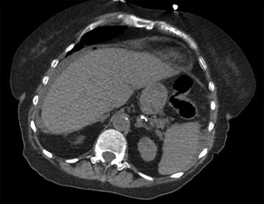 Transverse computed tomography showing intra-peritoneal free air under the diaphragm.