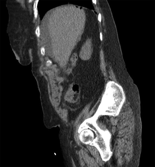 Sagittal computed tomography showing intra-peritoneal free air under the diaphragm.
