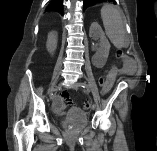 Coronal computed tomography showing a thickened inflamed bladder wall and irregular foci of hyperintensity within the bladder lumen.