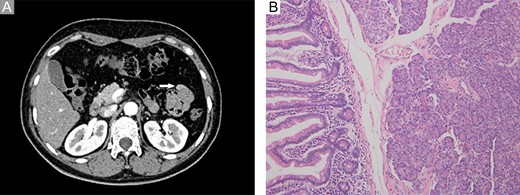 Imaging and pathological examination findings. (A) Computed tomography scan revealed a persistently enhanced mass (approximately 12 mm × 8 mm in size) located at the proximal jejunum (white arrow). (B) Histological diagnosis revealed ectopic pancreas dominated by acini within the submucosa and muscular layer; however, no malignant transformation or other complications were observed (200×, H&E).