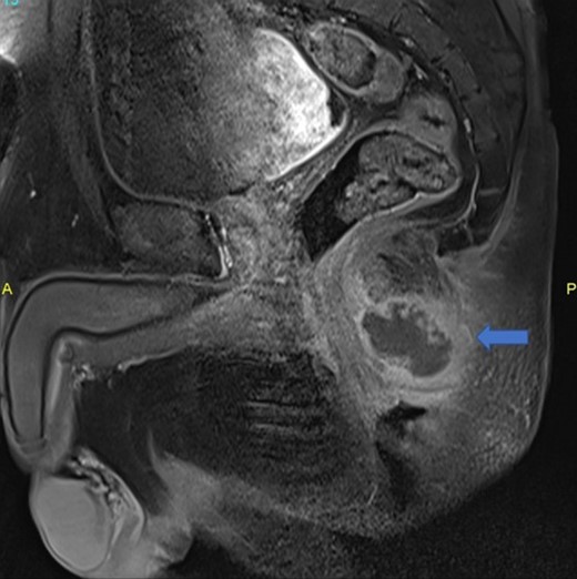 Posterior midline perianal fluid collection with thick enhancing walls was demonstrated on sagittal postcontrast fat saturated T1 weighted image (arrow) consistent with abscess.