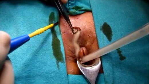 The abscess was drained with appropriate unroofing.