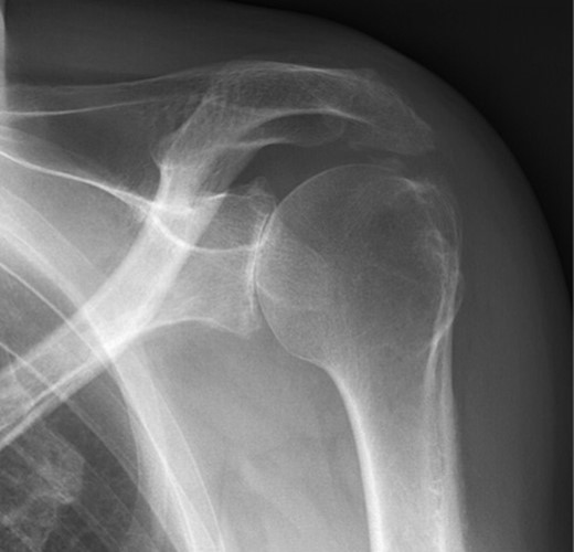 X-ray of left shoulder of patient with ochronosis. AP external rotation view showing glenohumeral osteoarthritis.