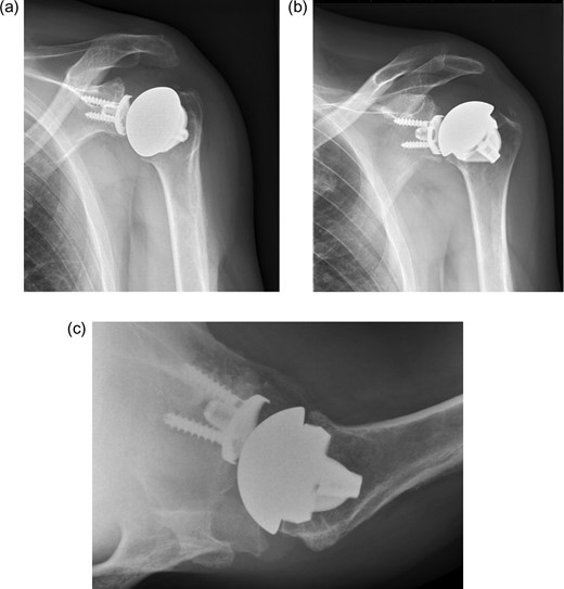 X-ray of left shoulder with total shoulder arthroplasty one year post-operative. (a) AP external rotation view. (b) AP internal rotation view. (c) Axial view.