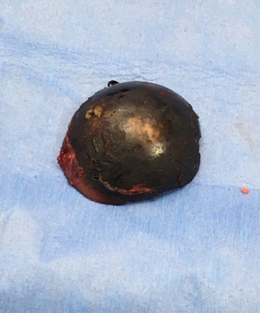 Humeral head of patient with ochronosis showing blackish discoloration of cartilage.