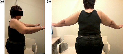 Range of motion of patient with bilateral total shoulder arthroplasty. a) Anteflexion. b) Abduction.