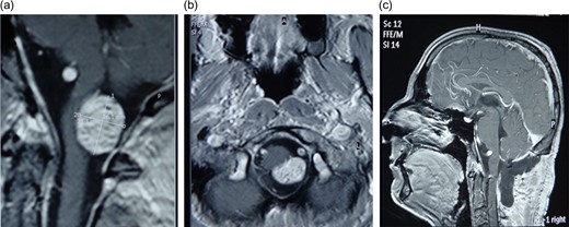 (a) MRI scan of first patient-Accesory nerve neurinoma sagittal plan (b) axial plane showing medulla attachment (c) postoperative MRI scan showing total tumor resection.