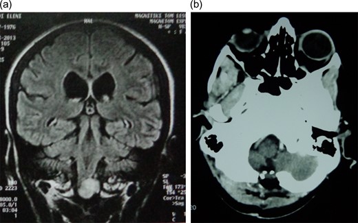 a) Coronal plane of preoperative MRI scan depicting a highly intense of foramen magnum of second patient. (b) Postoperative computer tomography (CT) scan showing total tumor resection.