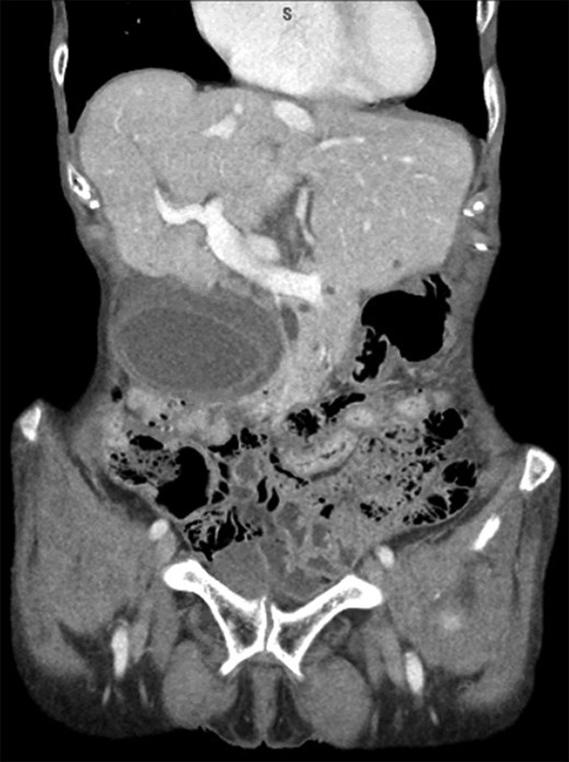 CT scan demonstrating a distended hydropic appearing gallbladder with pericholecystic fluid and wall thickening.