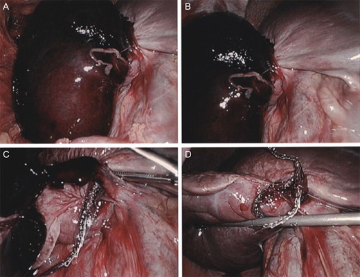 (a) Initial laparoscopic view of a severely distended and displaced gallbladder encompassing much of the RUQ. (b) Gallbladder base appears to have twisted upon itself and necrosed the base. (c) Transection across the gallbladder base with a GIA stapler. (d) Hemostasis achieved at transection size without damage to the liver.