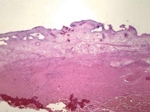 Histopathology revealed acute cholecystitis with hemorrhage and necrosis of the gallbladder.