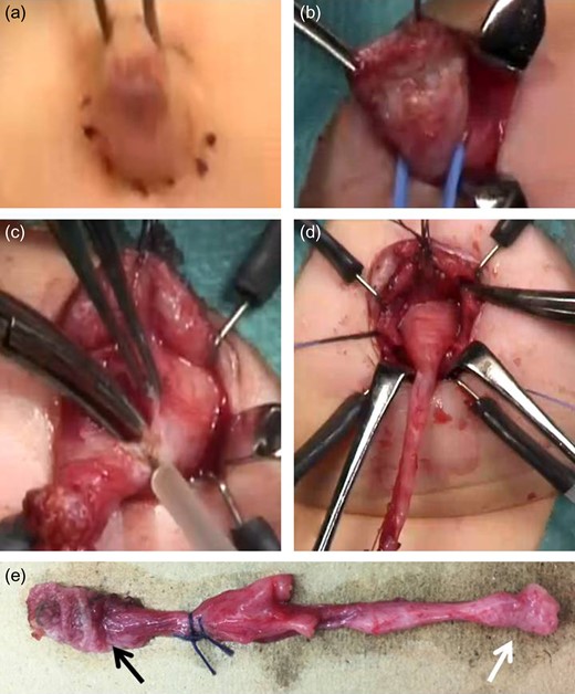 Surgical method 1. (a) Incision under the umbilical ring. (b) Entire resection of the fistula. (c) The umbilical edge of the urachal remnant is separated and the linea alba is divided in a T-shape. (d) The bladder cuff, including the urachal insertion site, is excised en bloc with the entire urachal sinus. (e) The resected specimen reveals a urachal remnant (black arrow: urachal sinus; white arrow: bladder wall).