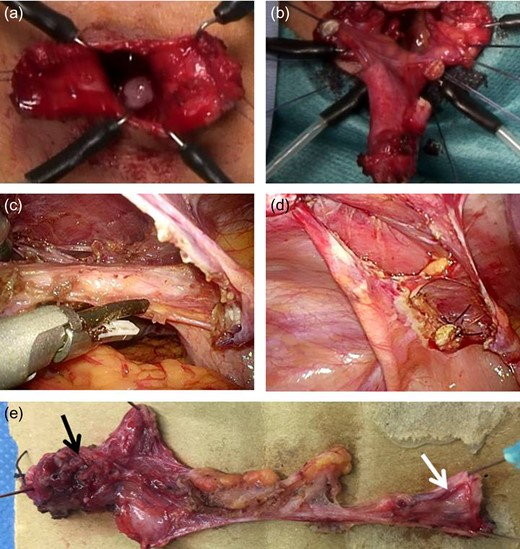 Surgical method 2. (a) The umbilicus is vertically divided to create a pair of lateral skin flaps, and the fistula is entirely resected. (b) The umbilical edge of the urachal remnant is separated, and the linea alba is divided in a T-shape. The partially resected urachal sinus is dropped into the abdominal cavity. (c) and (d): The bladder cuff, including the urachal insertion site, is ligated using an endoloop at the dome. The urachal remnant is resected at the dome of the bladder. e: The resected specimen reveals a urachal remnant (black arrow: urachal sinus; white arrow: bladder wall).