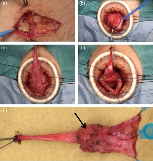 Surgical method 3. (a) A Pfannenstiel skin incision and a vertical midline fascial incision are made. (b) The cranial side of the urachal remnant is exposed and resected. (c and d): The urachal diverticulum is exposed and resected at the dome of the bladder, including resection of the bladder wall. (e): The resected specimen reveals a urachal remnant (black arrow: urachal diverticulum).