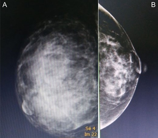 A mammogram of the breasts revealed a large circumscribed hyperechoic mass occupying nearly the entirety of the right breast and comprised multiple internal cystic areas, hypoechoic masses and internal vascularity (A), comparison with the left breast (B).