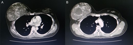 Computed tomography of the chest revealed a hypervascular mass in the right breast measuring 13.7 cm abutting the pectoralis muscle (A) cystic change measuring 5.3 cm in the mass is visible (B).
