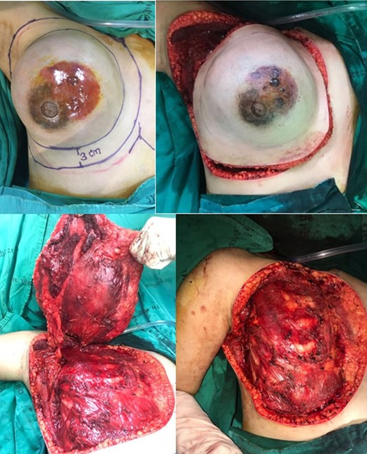 A right-side mastectomy with 3-cm margins with pectoralis major resection and axillary lymphadenectomy dissection was performed.