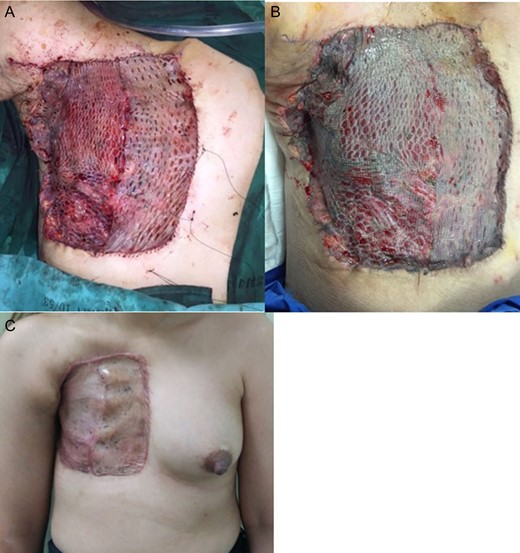 Coverage of the STSG immediately postoperative (A), 1-week postoperative (B), 2-months postoperative (C).