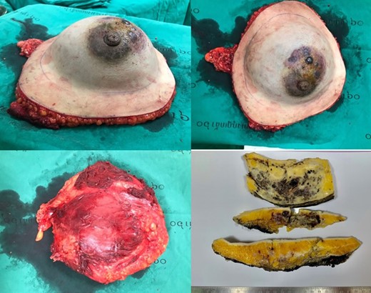 Surgical specimen measuring 23.0 × 20.0 × 9.0 cm and weighing 560 gm. with an axillary tail attached measuring 6.0 × 3.0 × 2.0 cm. The overlying 21.0 × 19.0 cm white/tan skin ellipse shows multiple skin nodules measuring 0.5–0.8 cm. The specimen was serially sectioned and revealed spongy hemorrhagic appearance with ill-defined borders, measuring 16.0 × 12.0 × 4.0 cm and located at the midline, under the nipple and close to the deep margin. The lesion was approximately located at 6.0, 6.5, 6.0 and 7.0 cm away from the superior, inferior, medial and lateral radial margins, respectively.