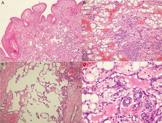 Histologic examination revealed low-grade angiosarcomas on sections of the skin nodules (A) and a mammary mass with lesions varying from well to poorly differentiated vascular neoplasms. The well-differentiated component comprised distinct anastomosing vascular channels that dissected the adipose tissue and lobular stroma (B). Neoplastic vessels had variably dilated or angulated lumina (C). The nuclei of the endothelial lining of the neoplastic vessels was prominent and hyperchromatic, but mitotic activity was infrequent, and there was typically no endothelial multilayering (D).