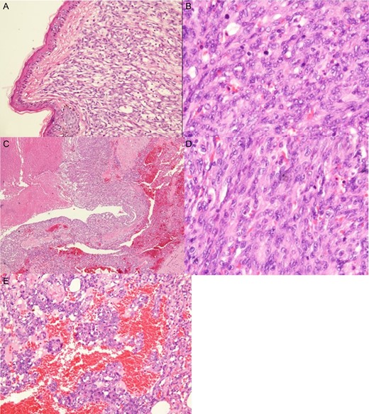 Histologic examination showed a high-grade angiosarcoma in the breast parenchymal section. The poorly differentiated component comprised easily recognizable malignant cells forming infiltrative solid cellular areas (A), with spindled-to-epithelioid pleomorphic hyperchromatic nuclei and abundant eosinophilic cytoplasm intermingled with anastomosing vascular channels (B). In addition, there were blood lakes, necrotic foci (C) and numerous mitoses (D), as well as endothelial multilayering and papillae (E) identifiable in the poorly differentiated areas.
