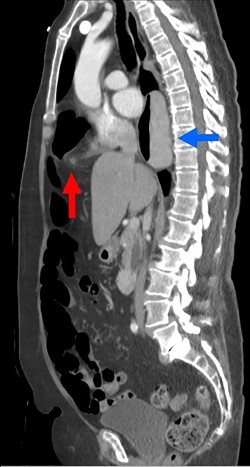 A sagittal view from the 2017 CT chest, abdomen and pelvis with IV and PO contrast demonstrates the Morgagni hernia with fat sweeping up through the diaphragmatic defect (red arrow) and a retrocardiac paraesophageal hernia (blue arrow).