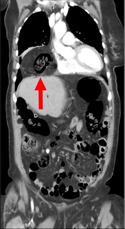 A CT chest, abdomen and pelvis with PO and IV contrast in 2017 shows bowel gas with mesentery herniating anteriorly through a diaphragmatic defect, consistent with a Morgagni hernia (red arrow) that has increased in size since 2015.
