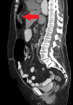 The CT abdomen and pelvis with oral contrast from 2015 pictured above led to an initial diagnosis of a Morgagni hernia, identified by the red arrow.