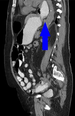 A CT abdomen and pelvis with oral contrast from 2015 demonstrates the presence of a PEH, identified by the blue arrow.