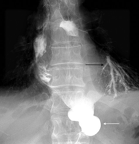 Barium swallow demonstrating the gastric conduit (white arrow) and left bronchial tree (black arrow).