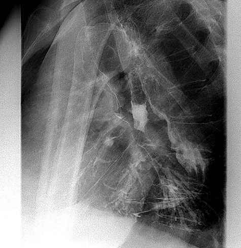 Lateral view of barium swallow demonstrating gastrobronchial fistula.