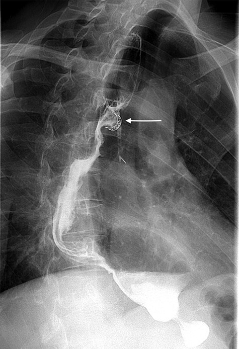 Postoperative barium swallow demonstrating the OTSC on the gastric conduit (white arrow) and no filling of the left bronchus.