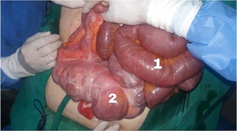 (1) Dilated small intestine proximal to the obstruction and (2) a 20 cm ileal mass.