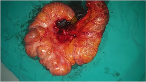 Excisional biopsy of the mass with part of the ascending colon.