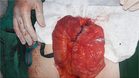 Primary ileocolic anastomosis.