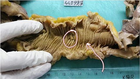 The cut surface of the terminal ileum reveals narrowing of the lumen and small polypoid thickness.