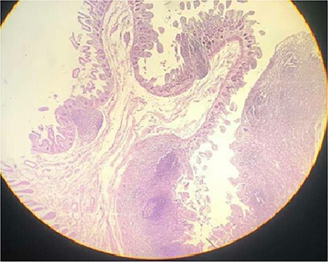 Sections through a diaphragm shows loss of the normal villous pattern suggesting regenerative changes and slightly fibrotic submucosa with muscle fibers running the plane of the muscularis mucosae rather than muscularis propria (hematoxylin and eosin stain) ×40.