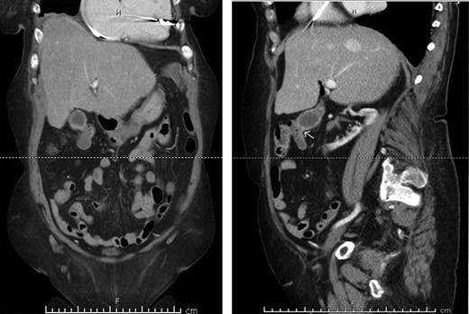 Preoperative CT enterography demonstrating a CCF; (a) coronal view and (b) sagittal view, the white arrow indicates the location of the fistula.