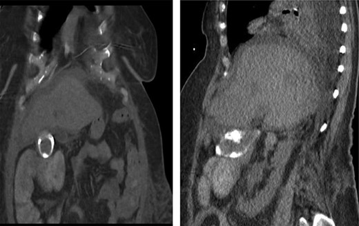 CT scan of the same patient during her hospitalization for cholangitis 5 years prior; of note, there is close proximity between the gallbladder and proximal transverse colon; (a) coronal view (b) sagittal view.
