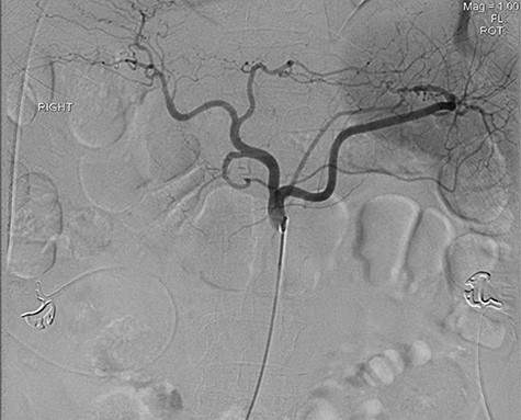 Demonstrating active extravasation of the GDA during a subselective GDA arteriogram