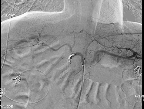 Demonstrating coil embolization of the GDA with no opacification